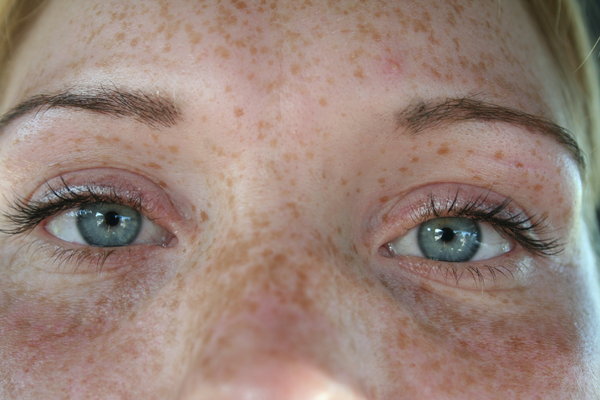 freckles...